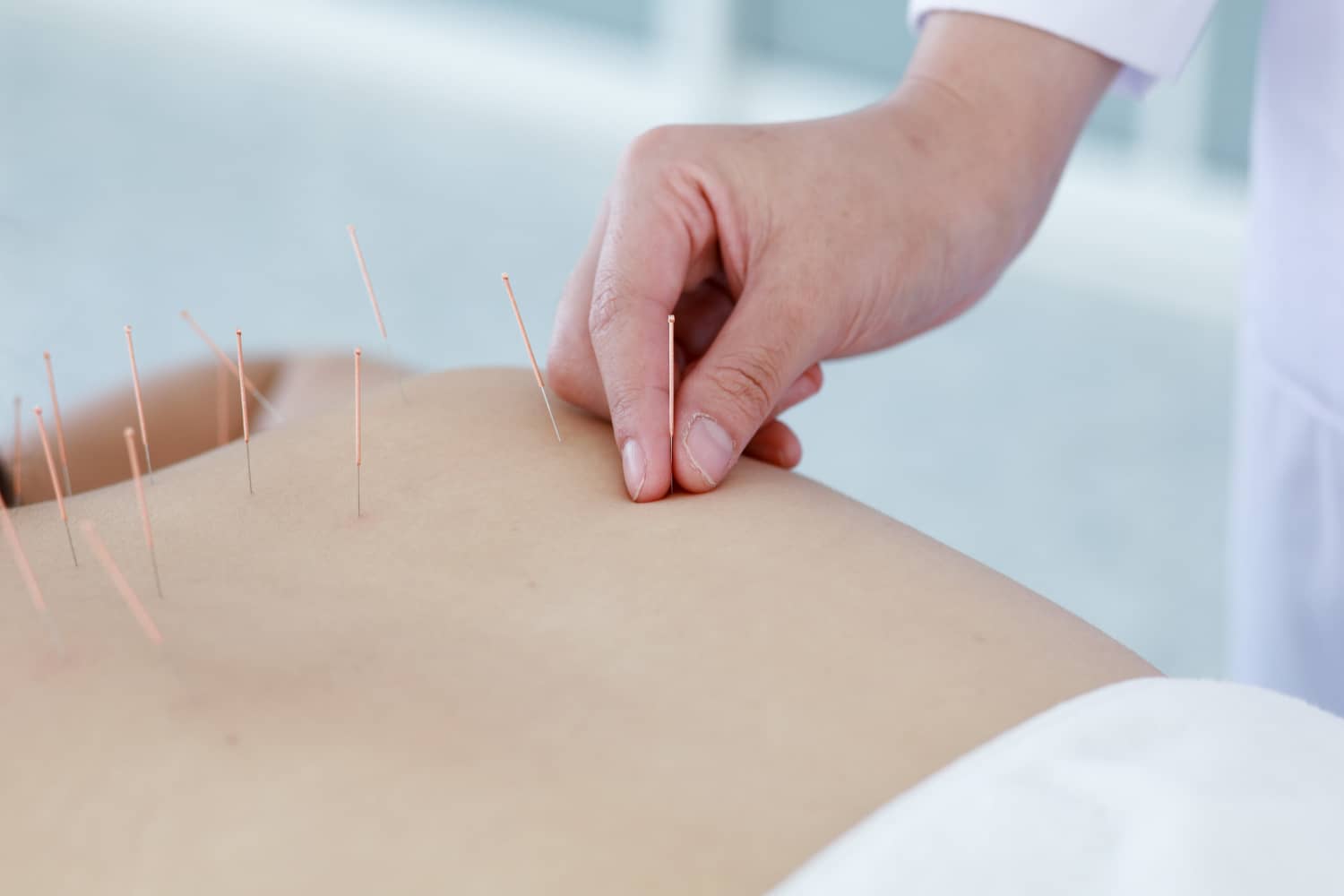 Acupuncture
